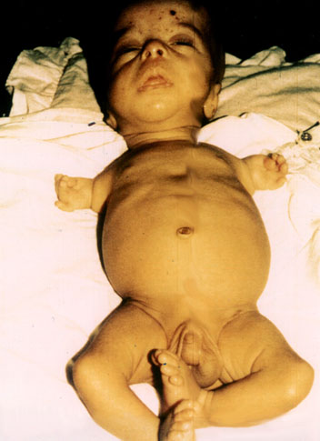 Deformed Iraqi baby caused by USA use of depleted uranium to hardened ammunition