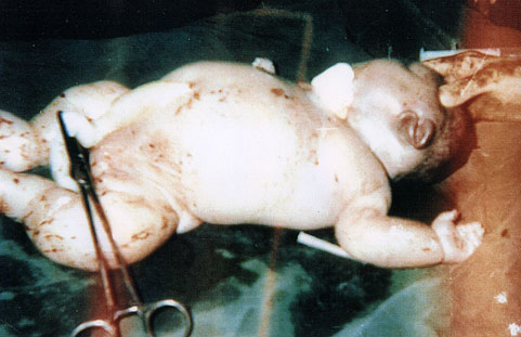 Deformed Iraqi baby caused by USA use of depleted uranium to hardened ammunition