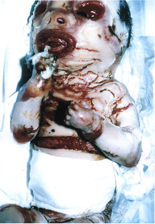 Deformed Iraqi baby caused by USA use of depleted uranium to hardened ammunition